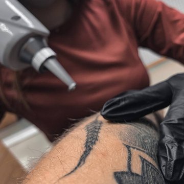Laser tattoo removal in Györ
