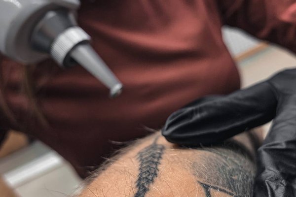 Laser tattoo removal in Szeged