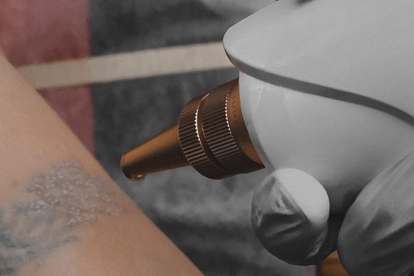 Laser tattoo removal in Budapest