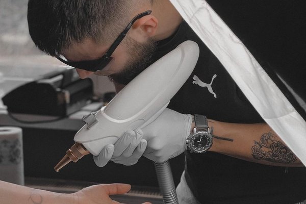 Laser tattoo removal in Budapest