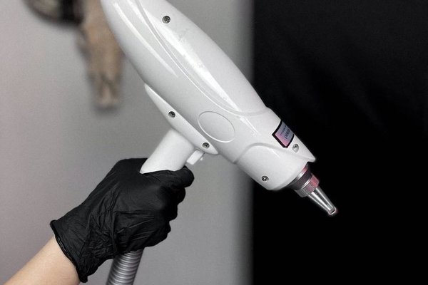Laser tattoo removal in Budapest