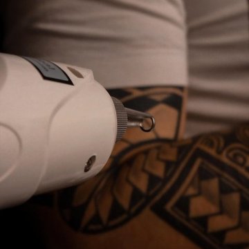 Laser tattoo removal treatments in Budapest